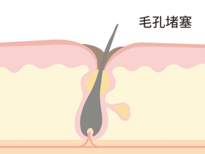 毛孔堵塞