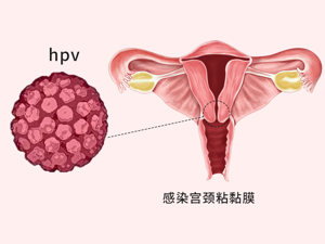 患者_HPV感染