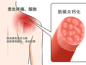 手腕_筋膜炎