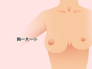 乳房_乳房内有大小不一的结节