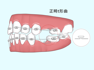 成年后_腺样体_正畸治疗