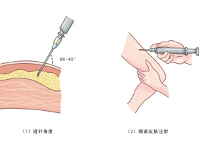 局部皮质类固醇注射