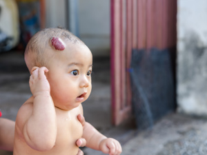 幼儿急诊高烧后斑秃会好吗