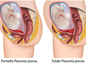 完全性前置胎盘啥意思