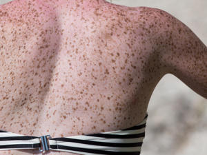 突发日光性皮炎?南京华肤皮肤研究所24小时随时回应