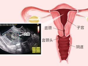 孕妇_经阴道超声检查