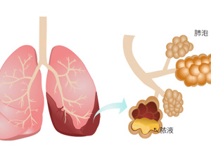 胸部_肺泡数量减少