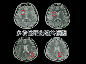 多发性硬化