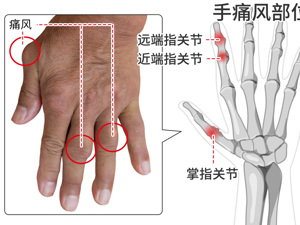 患者_痛风