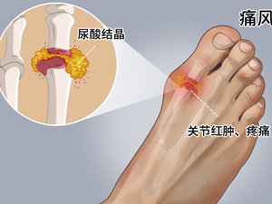 患者_高尿酸血症