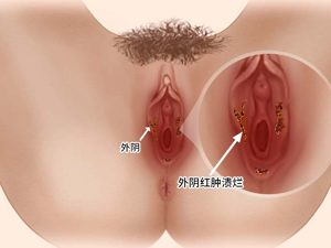 患者_阴道不规则出血