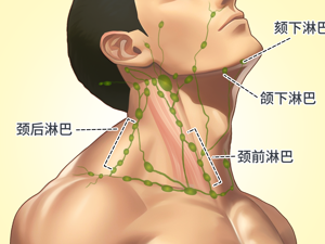 内淋巴囊引流术