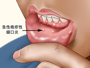 小儿_溃疡性口炎