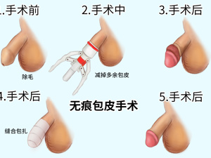 阴茎_包茎手术