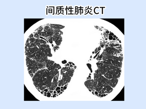 老人_间质性肺炎