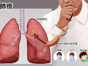 患者_肺结核