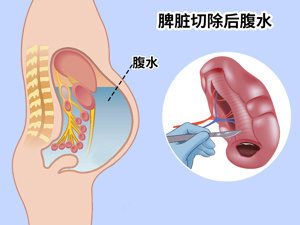 患者_腹水