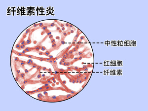 结核性脑膜炎