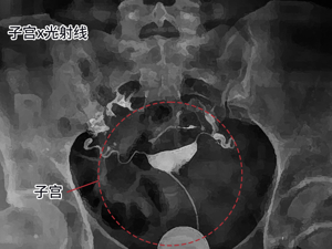 患者_输卵管粘连上举