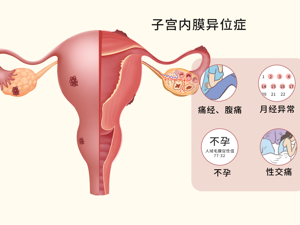 子宫内膜异位症