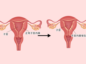 子宫内膜异常增厚