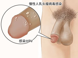 _HPV