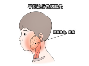 急性化脓性腮腺炎