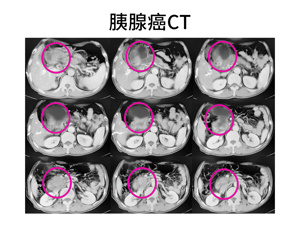 胰腺CT检查