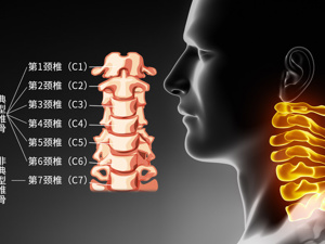 脊髓型颈椎病