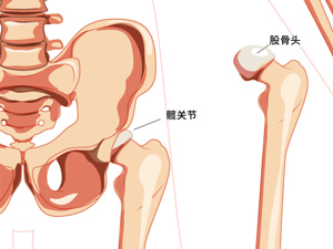 股骨头_骨骼结核