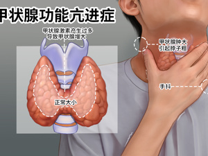 母亲_甲状腺功能亢进症