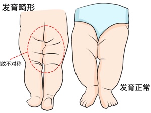 先天性发育异常