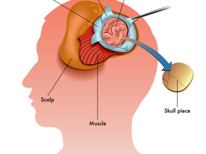 头颅骨骨折需要手术吗