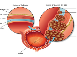 膀胱癌分几种类型