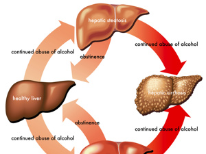 酒精肝肝炎能不到肝硬化吗