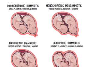 多胎妊娠类型包括