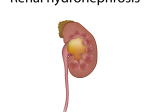 肾萎缩肾积水严重不