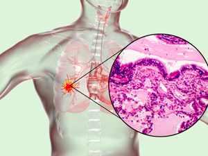 肺腺癌种类分三种类型有哪些