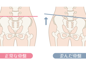 骨盆前倾做什么检查能查出来