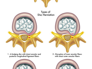 骨科在线:合肥治腰椎间盘突出哪个好?合肥中山骨科医院