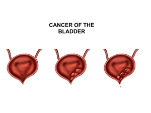 膀胱癌是什么类型的癌
