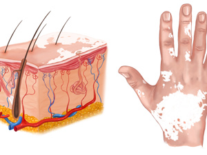 专业排名：陕西西安治疗白癜风（好的）医院-特发性白斑是什么原因导致的？