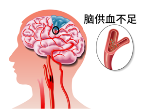 大脑供血不足