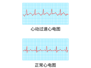 心脏_心跳加速