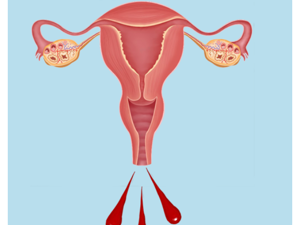 子宫_不规则出血