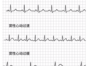 心脏节律异常