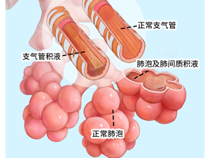排名一览:成都治哮喘病医院“今日更新”慢性支气管炎怎么引起的