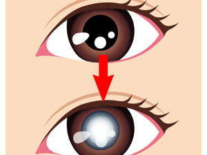 一个眼睛斜视可以矫正吗?上海普瑞眼科专家解答!