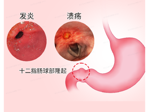 胃_急性肠炎