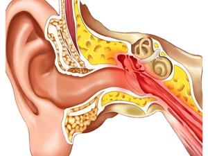 患者_中耳炎